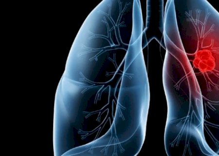 Saiba o que é adenocarcinoma pulmonar, câncer que atinge o papa